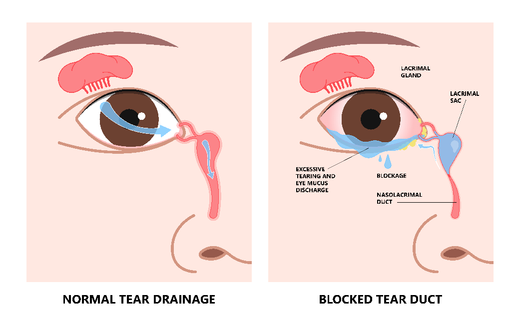 Blocked Tear Duct – DCR Surgery